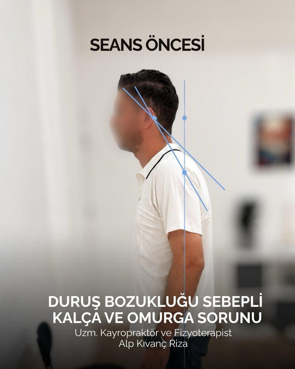Side view of patient before the session, head held forward